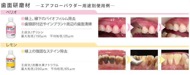 名古屋の歯のクリーニング